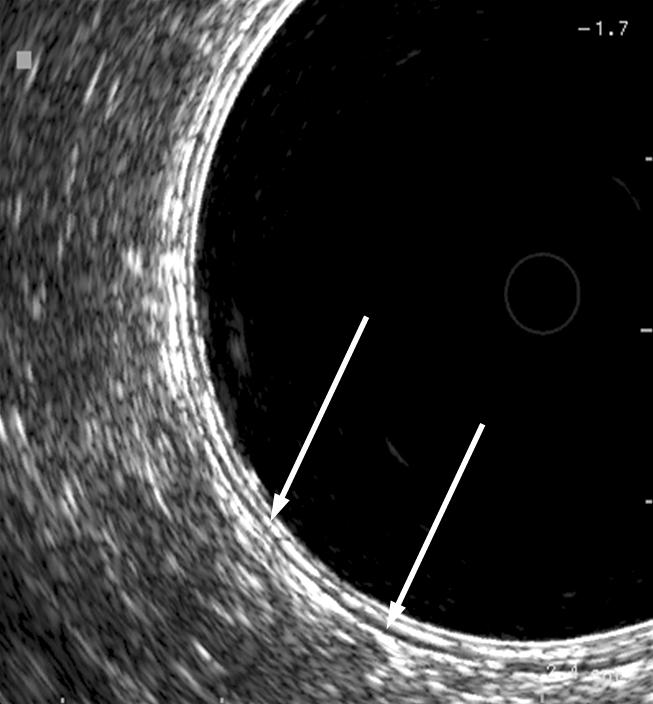 J Surg Ultrasound Vol. 1, No. 1, 2014 상태에서검사하게된다. 경직장혹은경항문초음파검사를실시하기전에반드시직장수지검사를통해직장의주행방향과종양의위치등을검사자가먼저파악하는것이필요하다. 경직장초음파검사는직장수지검사후직장경검사 (proctoscopy) 를통해직장암의위치및모양, 직장폐쇄정도등을관찰한뒤직장경을직장암의상부까지전진시킨다.