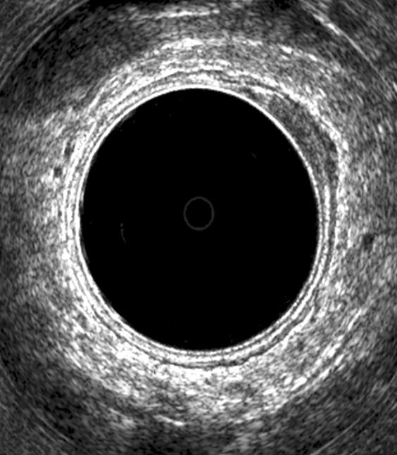 echo)을 보이는데, 이 층에는 여러 가지 정상조직 소견이 프절과 구별된다. 보인다. 상직장동맥이 관형으로 후방에 보이는데 위 아래 로 초음파 탐침자를 움직이면서 보면 연결되는 것을 관찰 3.