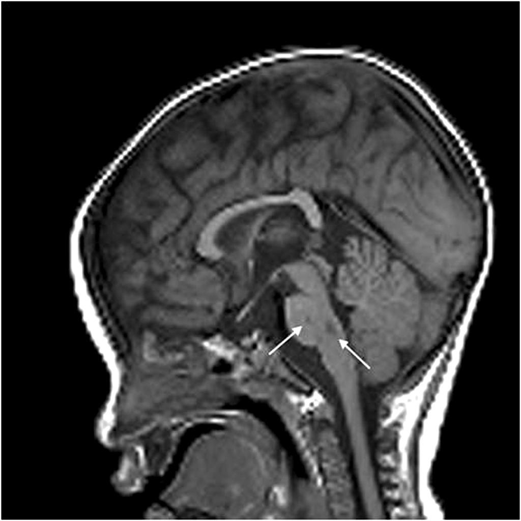 환아는 중환자실에 입원하였고 뇌자기공 명영상의 T2강조영상, 확산강조영상에서 양측의 측두엽, 전두엽, 두정엽 부분에 고신호강도를 보였다(Fig. 3).