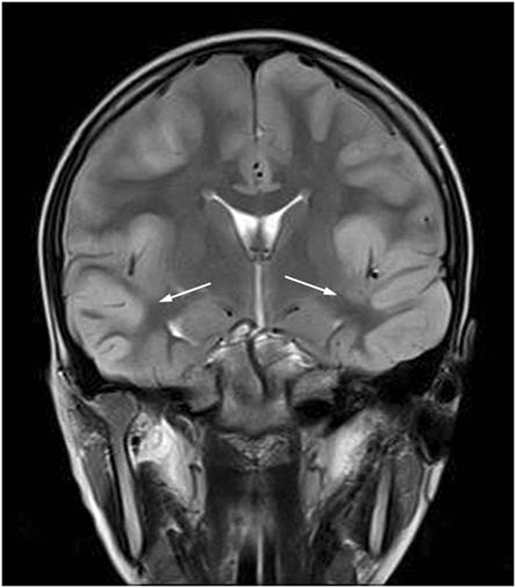 - 김민석 외 : EBV 뇌염 후 외향마비 - A B Figure 3. Brain M RI of case 2.