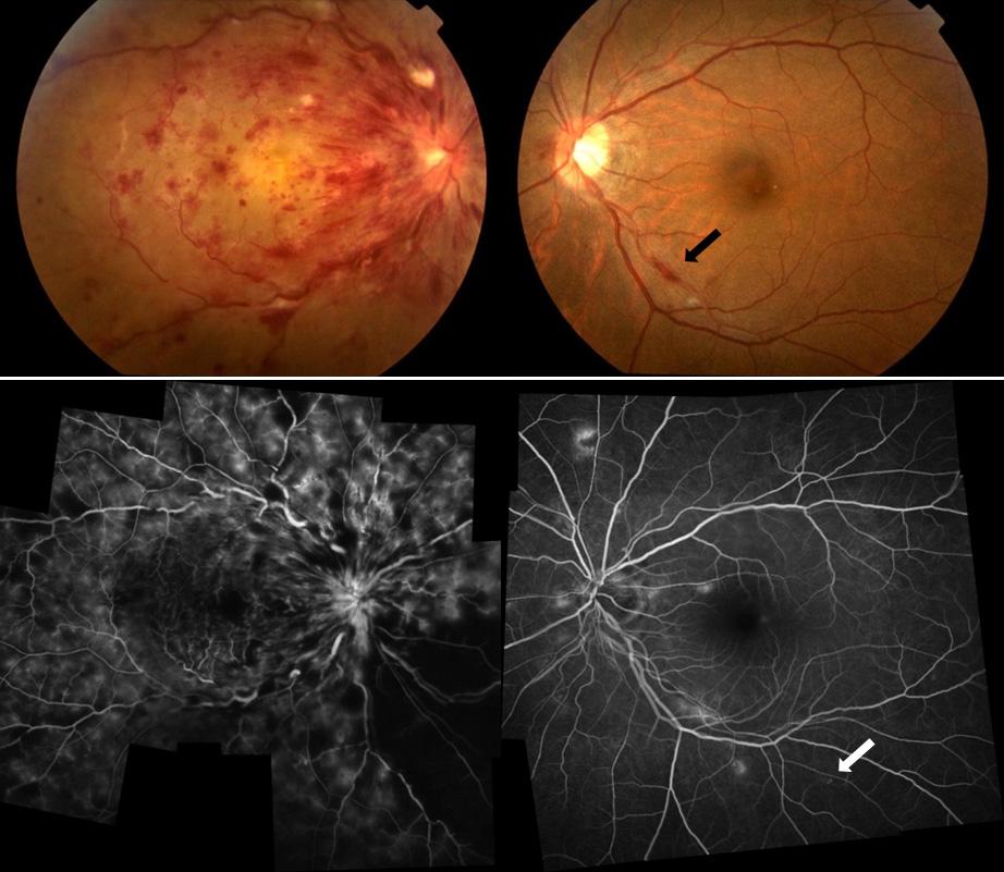 - 최화수외 : 안저검사로진단한당뇨환자의임상분석 - A B Figure 2. A case of central retinal vein occlusion (CRVO) in the right eye (Patient No. 5).