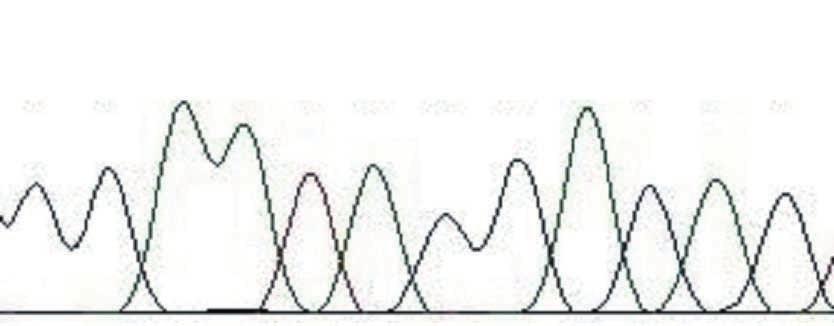 Sequencing analysis of HAX1. 5,104T G point mutation of exon 1 (A, C) and 5,474A G point mutation of intron 1 (B, D) in patient A and B, respectively.