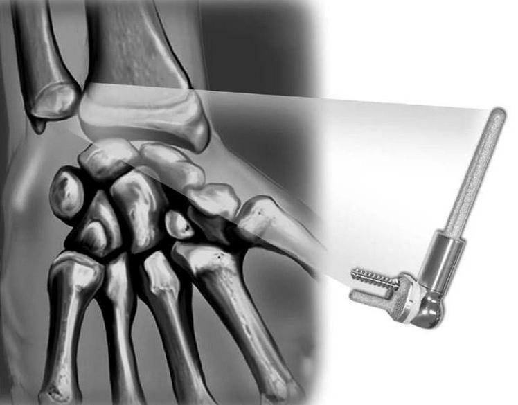 결론 Figure 17. Scheker semiconstrained total distal radioulnar joint arthroplasty (images courtesy of Aptis).