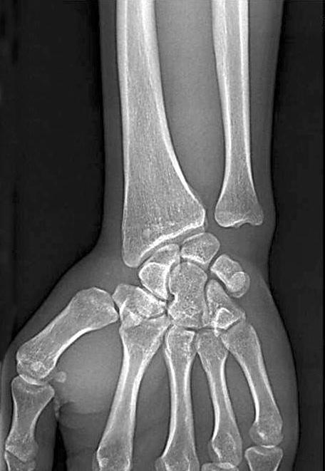 127 Distal Radioulnar Joint Arthritis A B C D Figure 4. (A) A 37-year-old man with history of right side radius fractures treated conservatively, suffered from intermittent ulnar-side wrist pain.