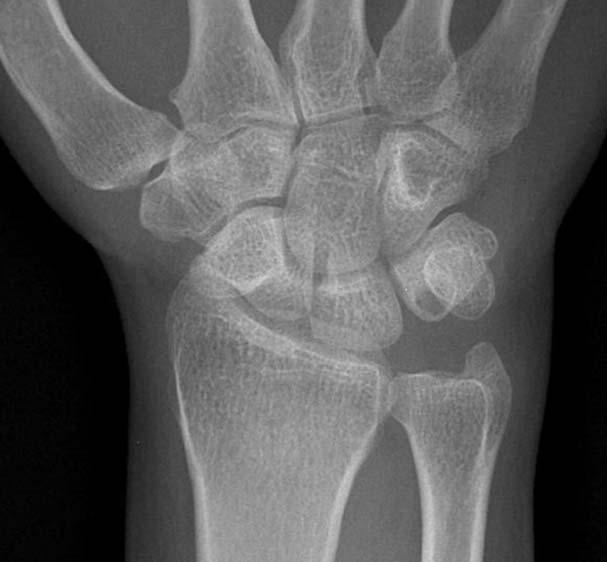 Chul-Hyung Lee, et al. Clinical Features and Treatments of Carpal Bone Cysts Table 1.