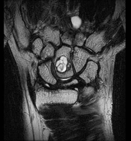 고찰 4) 증례 4 52세남성의제3수근-중수지관절에발생한완관절결절종의수술차내원하여시행한단순방사선촬영상두상골의골낭종소견보이고 (Fig.