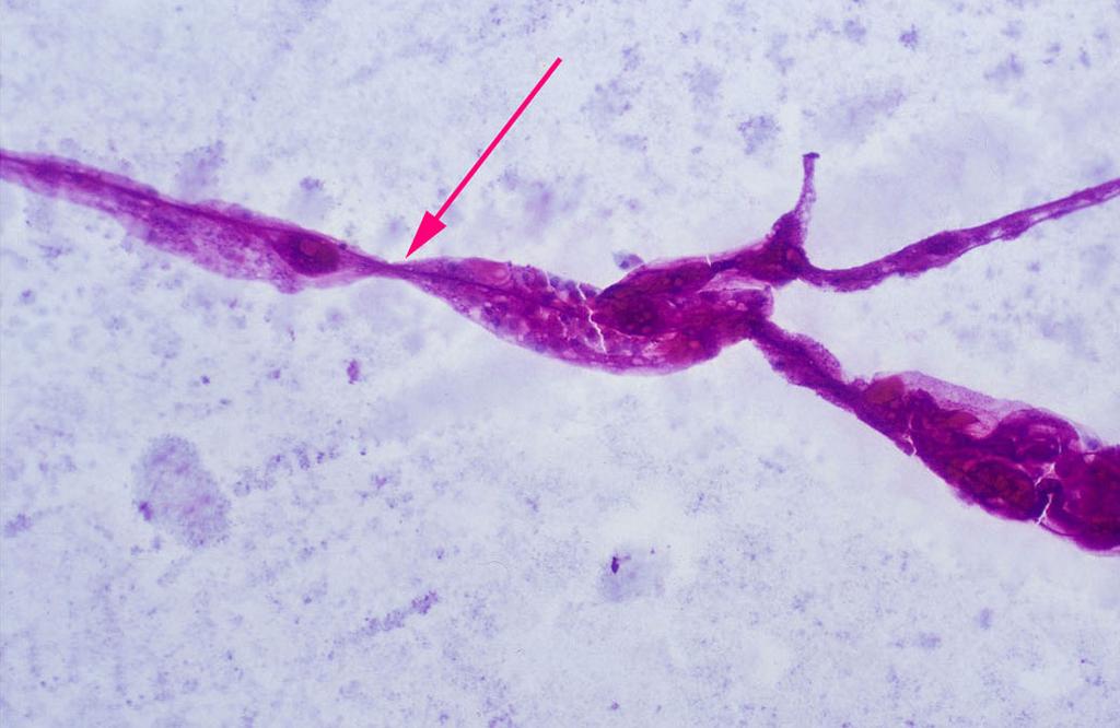 The keratoconjunctivitis sicca group shows signigicantly less amount of mucin than other groups (p < 0.05).