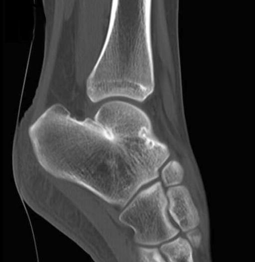 Preoperative standing lateral radiographs (, ) show bilateral talocalcaneal coalition without pes