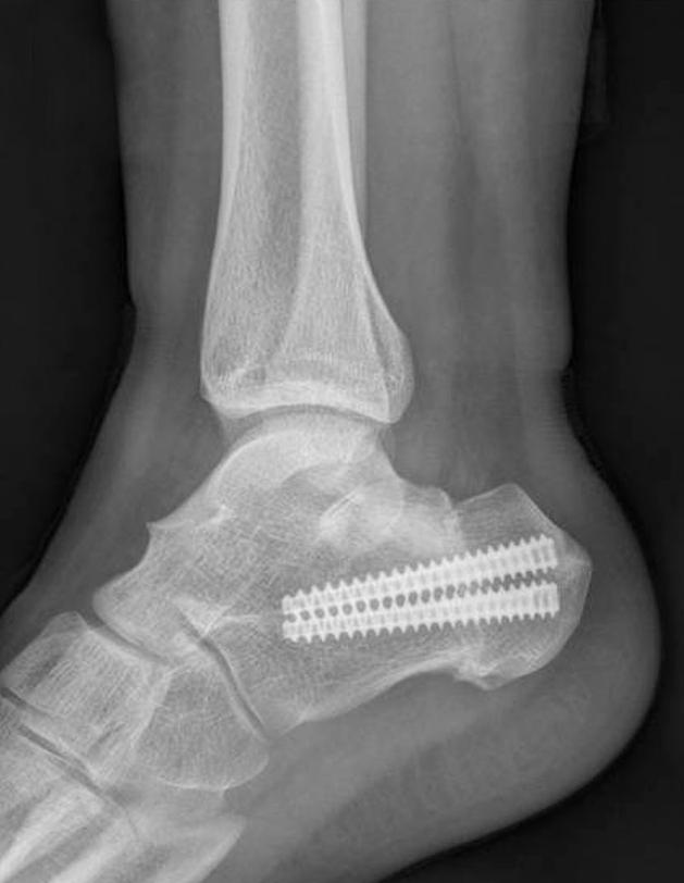 Follow-up radiographs at postoperative 1 year (, ) show the union of osteotomy site. Figure 4.