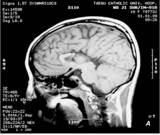 - 조윤영외 6인 : 이차성무월경증이동반된태아알코올증후군 1예 - Fig. 3. Brain MRI Shows hypogenesis of the corpus callosum with colpocephaly (A) and ectopic neurohypophysis at the pituitary stalk (B). 시행하였으며현재추적이되지않고있는상태이다.