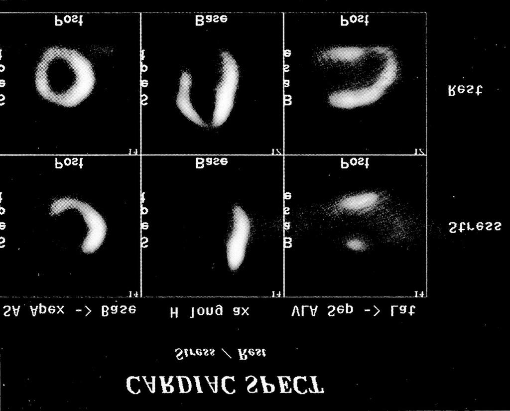 Fig. 3. 근위좌전하행지 Proximal anterior descending artery에 90% 협착이있었던남자 52세협심증환자의 adenosine 부하 Tc-99m tetrofosmin SPECT 소견. Table 5.