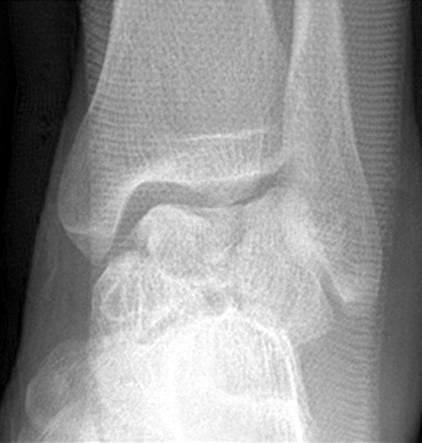 (C, D) Postoperative radiographs show a fixation using multiple screws and lateral plate with dual (anteromedial & anterolateral) surgical