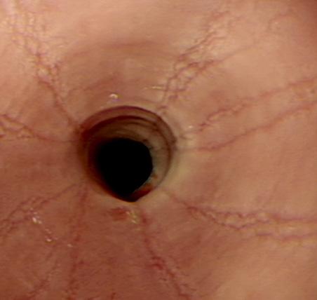 Endoscopic Features Associated with Eosinophilic Esophagitis 1 Linear furrowing, vertical lines of the esophageal mucosa White exudates, white specks,