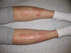 174 Case Study of Soyangin Patient with Psoriasis 13.