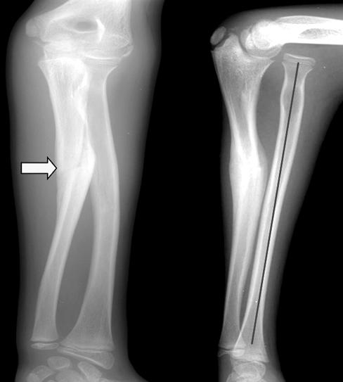 (B) Open reduction, reconstruction of the annular ligament and ulnar osteotomy were performed 3 months after the injury.