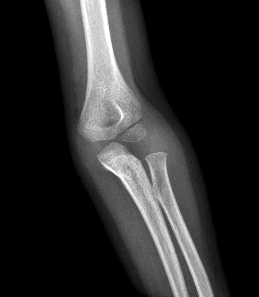 (B) Both the distal part of the ulna (gray) and the radius (gray) were mobilized to localize point b