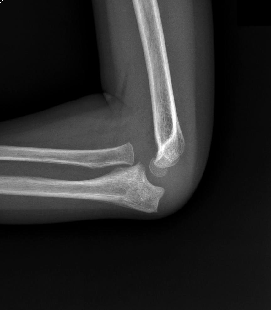 0 mm to avoid excessive pressure on the radiohumeral joint after radial head reduction.