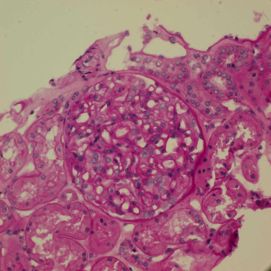 - Hee Kyung Ahn, et al. A case of membranous glomerulonephritis associated with apocrine carcinoma - 한구조를보이지않았으며, 각각의세포는경계가불분명하였고, 풍부한호산성의세포질과중등도의과염색성핵을가지고있었다 ( 그림 ).