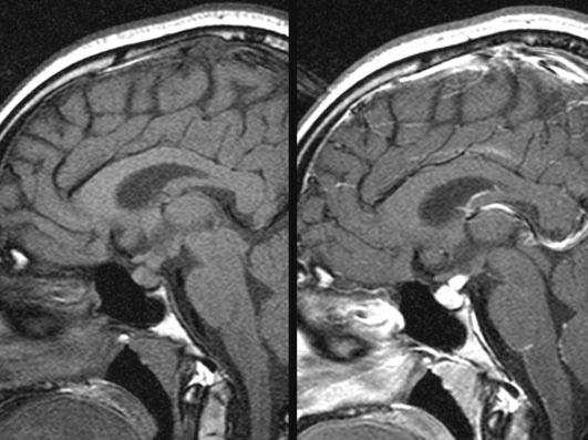 The normal posterior bright spot' on T1 weighted image is lost and pituitary gland is enlarged. Pituitary stalk is thickened with marked contrast enhancement. Fig. 2. Sellar MRI after 45 days later.