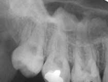 치아들의치조백선이나치주인대강의두께등을확인할수있으므로인접치아의치근단염증등과같은임플란트의예후에불리한상황들을조기에확인하여치료할수있다. Fig. 1. Bony septum within maxillary sinus. 임플란트시술을하기위한방사선검사에서확인하여야할목록들 임플란트시술을하기위한방사선검사에서확인하여야할목록들을정리해보면다음과같다.