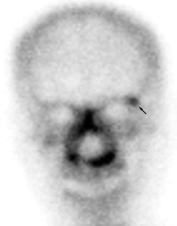 Anterior view of the bone scan shows discrete focal activity in the left superior lateral margin of the orbital rim (arrow).
