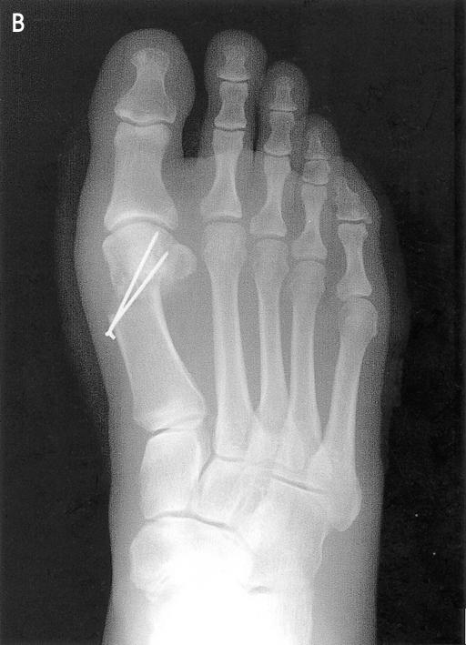 release of right foot. (A) The preoperative AP radiograph of the both feet shows severe hallux valgus deformity. (B) The radiograph after month from the operation still shows good alignment.