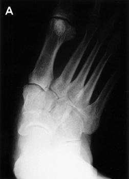 lump, with rockerbottom deformity and sagging at the tarsometatarsal joint.