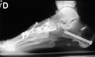 had pes planovalgus and forefoot abduction deformity with a 5 year history of midfoot pain.