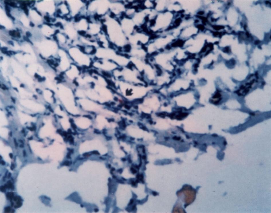 8 4/50 28 14/50 Chronic tonsillitis in adults 30 15/50 6 3/50 30 15/50 Healthy adults 35 7/20 0 0/20 10 2/20 ITHIdiopathic Tonsillar Hypertrophy Fig. 3. In Situ Hybridization.