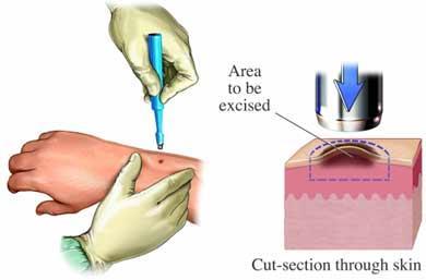 4) Skin biopsy 방법 면도생검 :