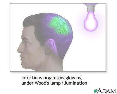 A Wood s lamp 는 long wave ultraviolet