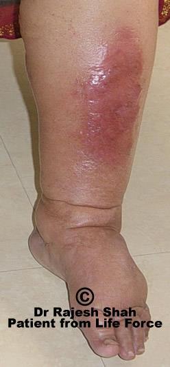 Cellulitis