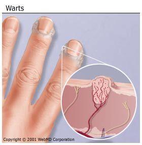 바이러스성감염 : 사마귀 (Warts, verrucae) 원인 : HPV ( 인간유두종바이러스 ) 종류 / 증상 심상성사마귀 (verrucae