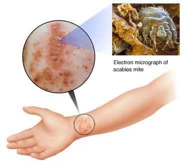 기생충감염 : 옴 (scabies) 역학 옴은암컷진드기에의해발생 인구과밀, 위생불량시에만연 난잡한성생활, 해외여행으로발생율증가 병원감염 어린이, 젊은성인호발 증상