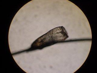 capitis) 몸의이 (pediculosis corporis) 치부이