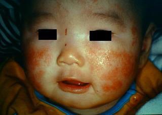 유아형 : 5 개월된아기의얼굴.