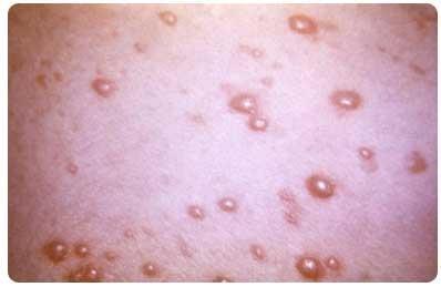 수포성질환 : 천포창 (pemphigus) 피부와점막을파괴시키는자가면역질환
