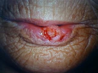 피부암 (2) 편평세포상피종 (Squamous cell epithelioma) 얼굴, 입술, 입, 손등 궤양, 편평한붉은부위, 피부각질,