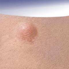1 차적병소 결절 (nodule) 피부면에융기된덩어리병소 구진보다깊고, 단단