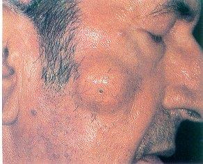 낭 (cyst) 피부나피하층에싸여있는덩어리로융기