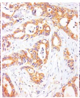 nucler positivity in the tumor cells (A).