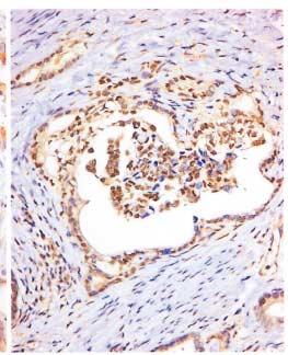 The tumor cells demonstrte cytoplsmic rectivity for VEGF (B), nucler stining pttern for the c-myc (C) nd
