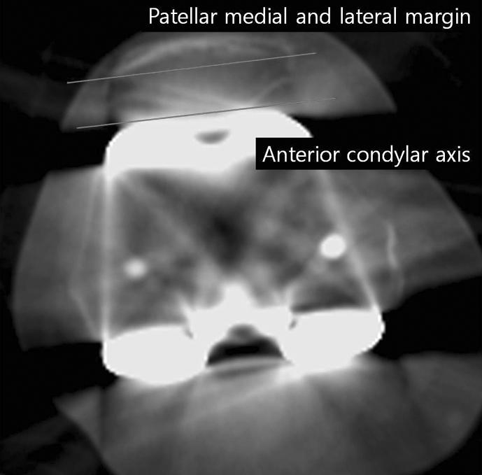 98 대한슬관절학회지 : 제 23 권제 2 호 2011 Volume 23, Number 2, June 2011 Fig. 2. Patella tilt angle is formed by the anterior condylar axis and the line connecting the medial and lateral patella margin.