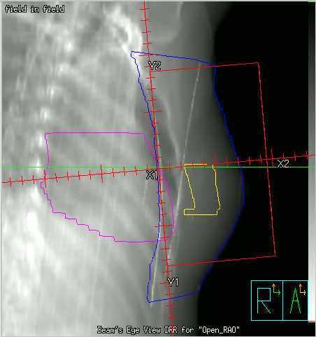 b1-2) In FIF, initial calculation of two equally weighted open tangential field displayed under and over dosage volume.