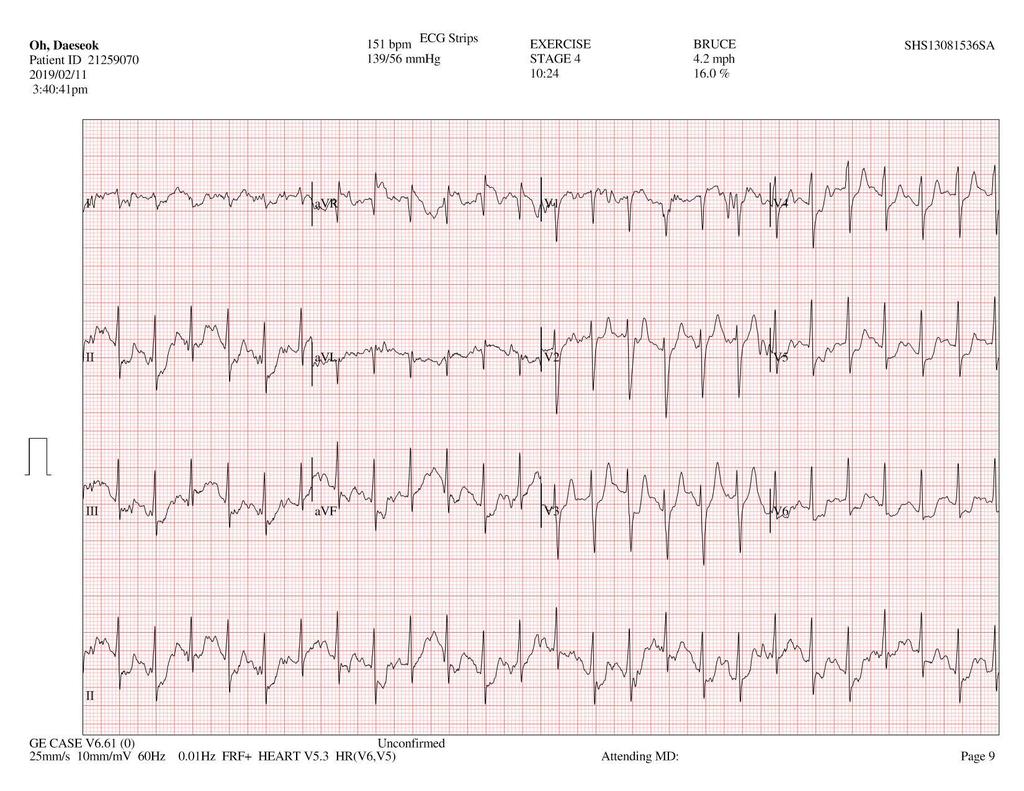증례 M/58 ECG: NSR 74 bpm CXR: No cardiomegaly, no pulmonary edema, no active lung lesion Echocardiography: Normal LV