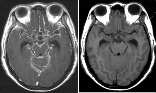 - Hee Jun Kim, et al. Neurocutaneous melanosis (NCM) in an adult - A Figure 2. The lesion showing high signal and low signal intensities on T1 (A) and T2 (B)weighted MR image, respectively.