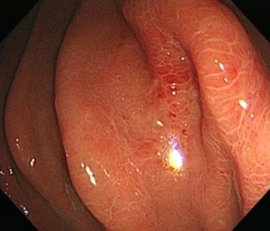 Human gastric anisakidosis.