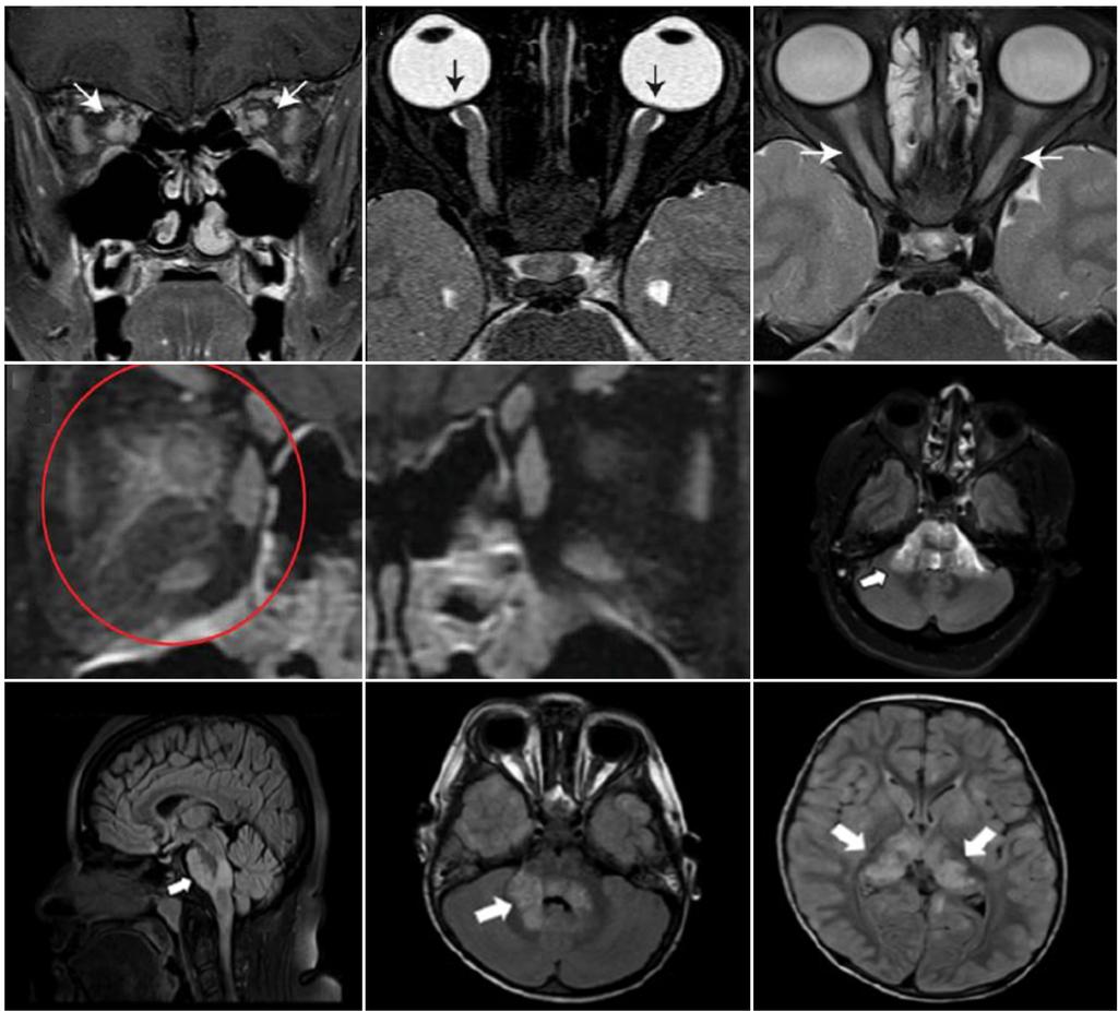 류성근 박민수 A B C D E F G H I Figure 2. Radiological characteristics in optic neuritis with myelin oligodendrocyte glycoprotein (MOG)-immunoglobulin G central nervous system inflammatory disorder.