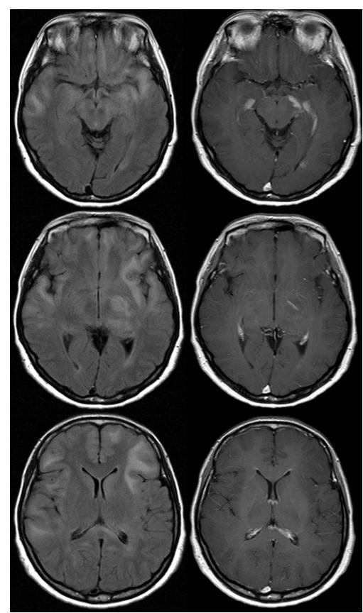 박형준신하영이형석유한수김승민 A B C Figure 1. Brain MRI and pathologic findings for case 1.