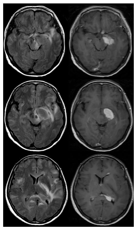 (B) Follow-up brain MRI revealed extension of the previous lesions and development of new mass lesion in left lateral ventricle.